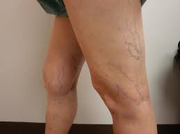 Varicose Veins