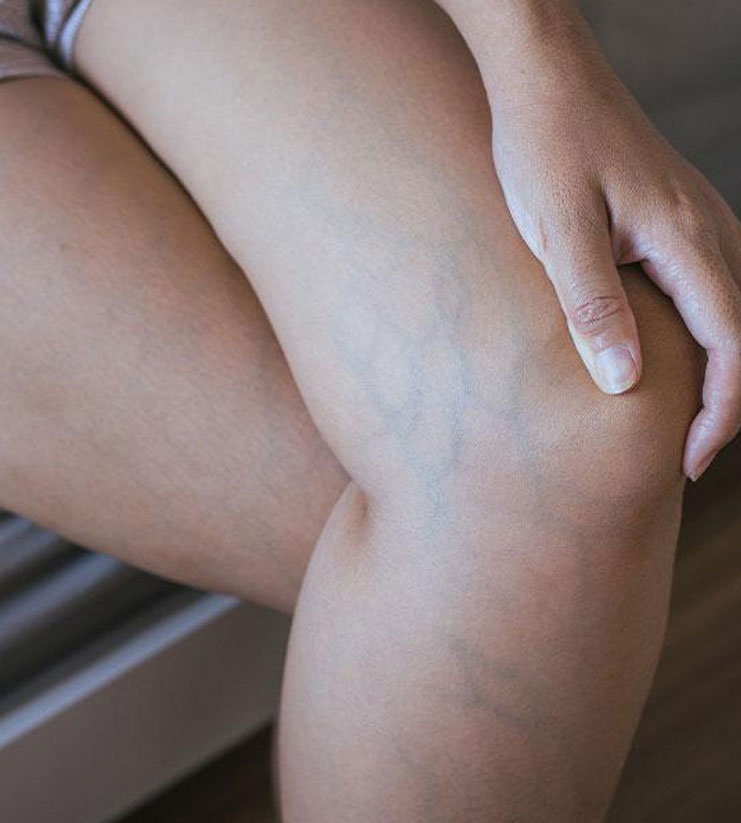 Varicose Veins